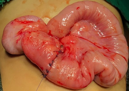 Best Pediatric Urologist in Ahmedabad, Child Urologist in Ahmedabad, Hirschsprung’s disease in Rajasthan, Hirschsprung Disease Treatment